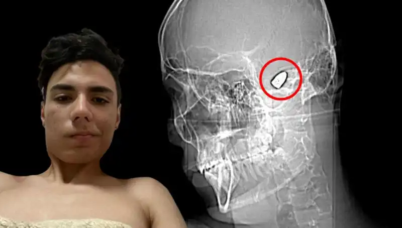 Kafasında Patlayıcıyla Gezen Birey, Yaşadığı Dramanın Detaylarını Açıkladı